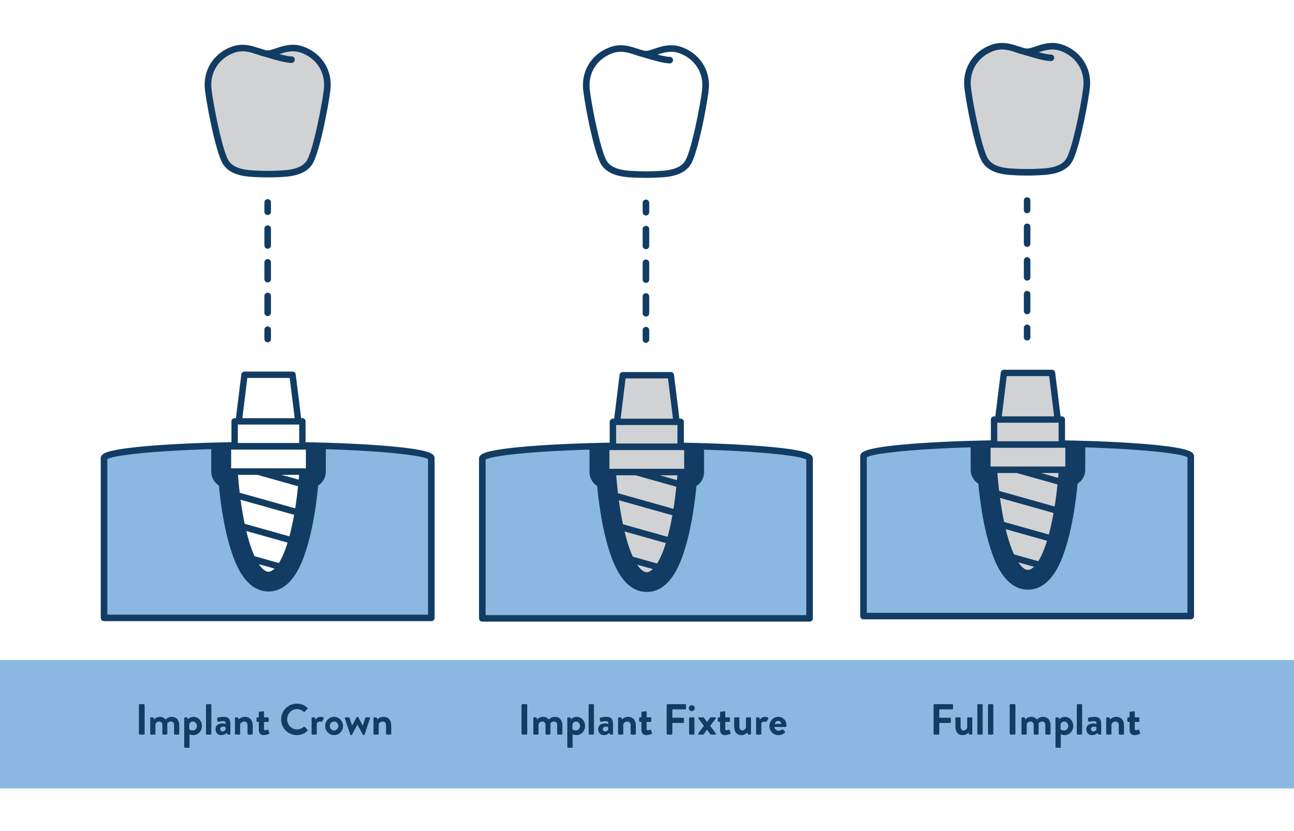 Dental Implants Melbourne VIC City Smiles Dentist