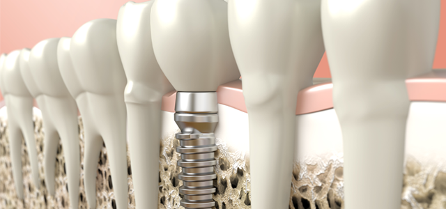 dental implants Melbourne