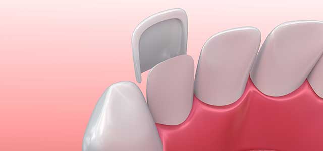 pros-and-cons-of-veneers